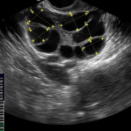 Follicular Monitoring