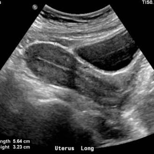 Pelvic Ultrasound